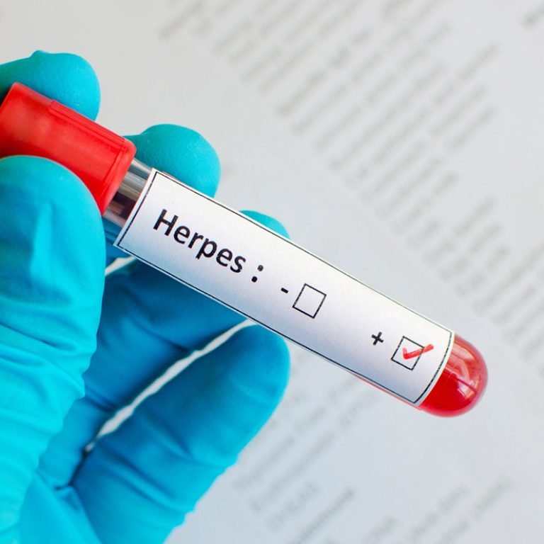 Herpes-Testing1